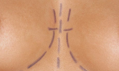 Breasts marked for plastic surgery