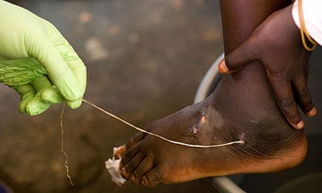 A guinea worm is extracted by a health worker from a child's foot in Savelugu, Ghana
