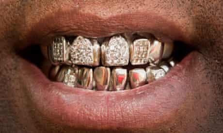 Big picture: Gold teeth