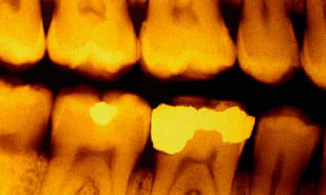 Dental x-ray trial