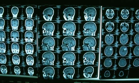 CT scans warning after study claims too many could lead to brain cancer | Health | The