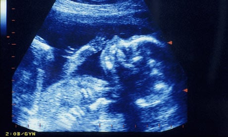 Ultrasound foetus scan