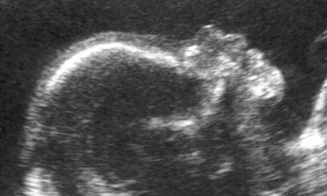 Ultrasound scan of 20-week-old fetus