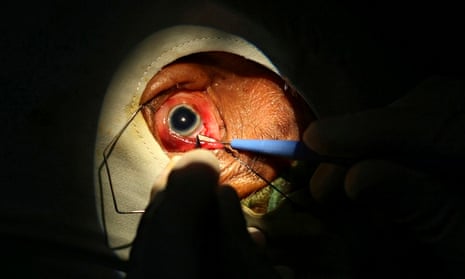 A doctor carries out a cataract operation