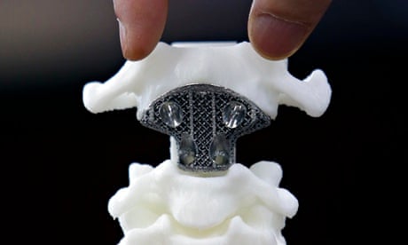 Spine model implanted with a 3D-printed artificial axis 