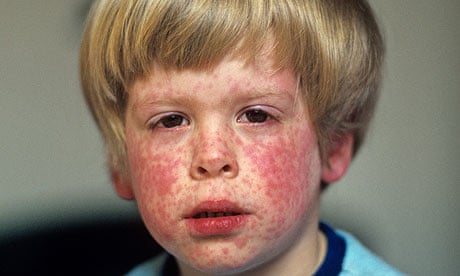 measles rash on face of infant patient