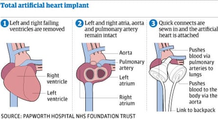 Graphic: artificial heart