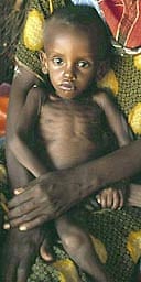 Malnourished child in Denan, Ethiopia