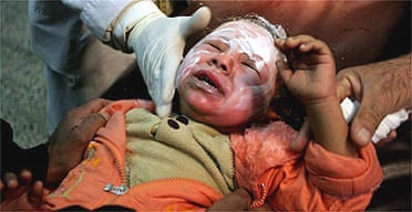 Iraqi doctors treat a young girl for burns