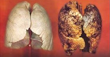 smoking cigarettes can harm smokers by Smokers to face graphic picture warnings | Health smoking cigarettes can harm smokers by Smokers to face graphic picture warnings | Health