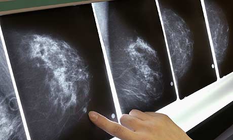 Mammogram scans for breast cancer