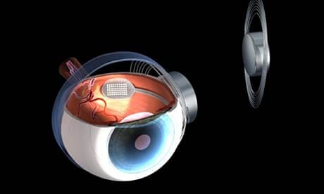 Biooptics Eye 'Bionic' eye gives blind people some sight | Medical research | The ...