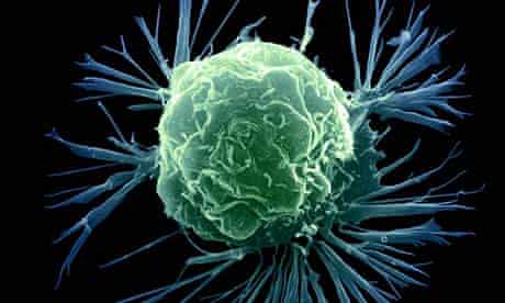 A colour enhanced scanning electron micrograph (SEM) of a breast cancer cell