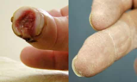 Finger which grew back after 'pixie dust' treatment