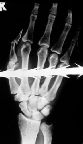 X-rays of torture: Torture x-rays