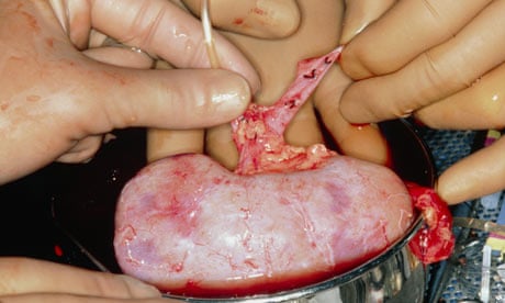 kidney transplant donor scar