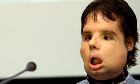 Oscar, the world first full-face transplant patient