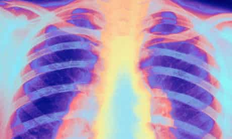 tuberculosis x-ray