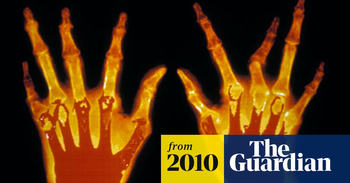 Failure To Act On Early Signs Of Rheumatoid Arthritis Could Prove Fatal British Science Festival 2010 The Guardian Failure To Act On Early Signs Of Rheumatoid Arthritis Could Prove Fatal British Science Festival 2010 The Guardian