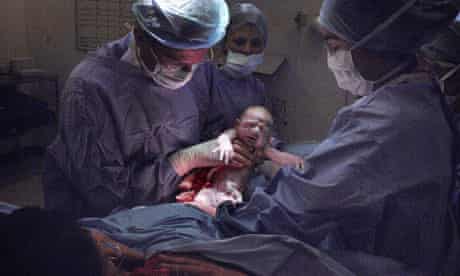 A baby delivered by caesarean section