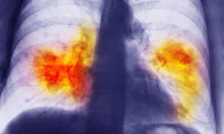 Lung cancer tumours