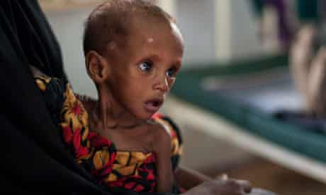 starving somali child