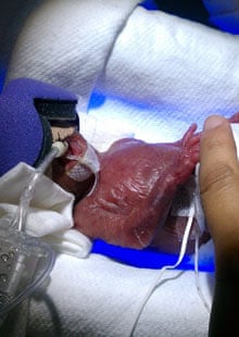 pictures of the smallest baby in the world