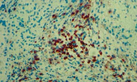 Stem cell transplants rejected in surprise setback for new ...