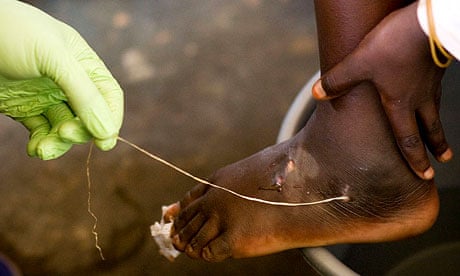 guinea worm, dracunculiasis, is extracted from a child's foot in Savelugu
