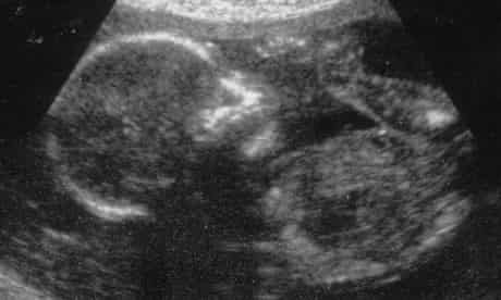 A foetus in a woman's womb