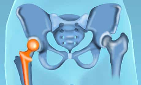 A hip replacement implant