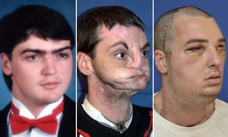 Richard Norris before and after his face transplant 