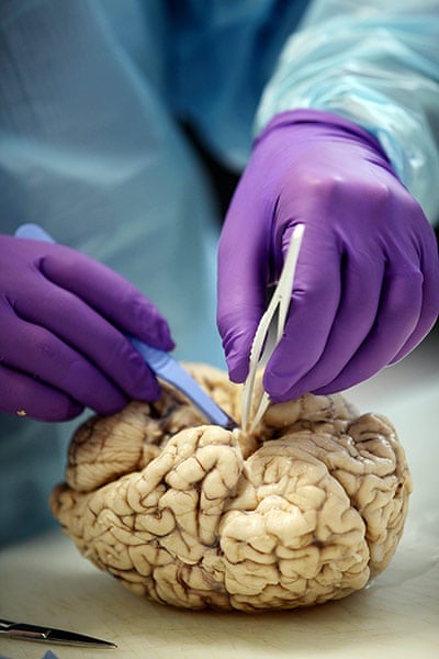 A human brain dissection – in pictures | Science | The Guardian