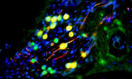 Human nerve cells repopulate a gerbil's cochlea