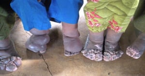 elephantiasis feet