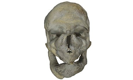 Skull from Digitised Diseases website