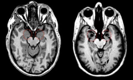 MRI brain scans of healthy and damaged amygdalas