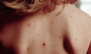 Start of measles symptoms Start of measles symptoms