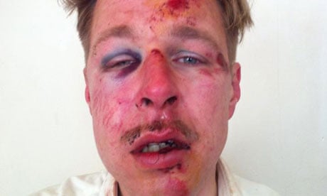 Gay man reveals bloodstained 'face of French homophobia' on Facebook |  France | The Guardian