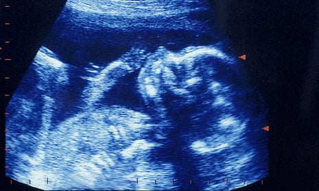 Ultrasound scan of foetus at twenty weeks