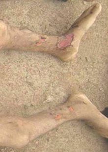 Ulceration on the lower shin and foot of a Syrian detainee