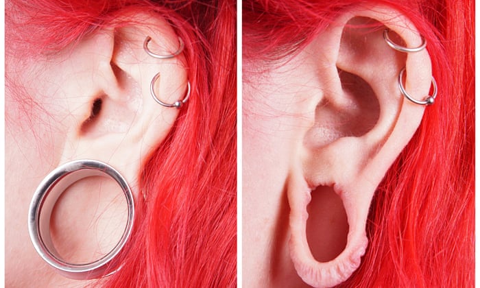 Big Increase In Surgery To Mend Flesh Tunnel Earlobes Life And