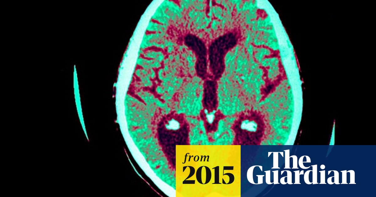 Alzheimer S Breakthrough Ultrasound Successfully Treats Disease In Mice Alzheimer S The Guardian Alzheimer S Breakthrough Ultrasound Successfully Treats Disease In Mice Alzheimer S The Guardian