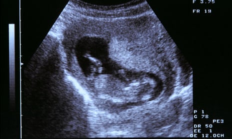 ultrasound two month old foetus