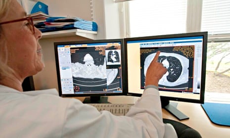 A physician examines a CT scan of a lung in the X-Ray Dept at St. Gorans Hospital