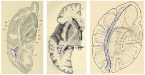Illustrations from 1880s brain atlases by Carl Wernicke (left), Heinrich Obersteiner (middle), and Heinrich Sachs (right) showing the vertical occipital fasciculus in the monkey and human brain. From Yeatman, <em>et al</em> (2014).