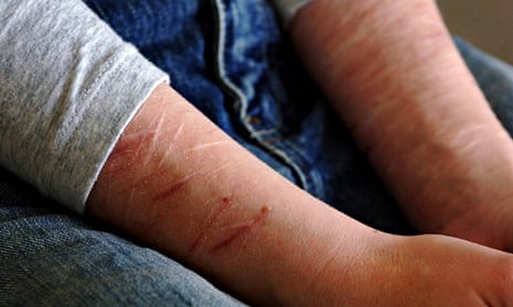 Young person's arms covered in scars as a result of self harm