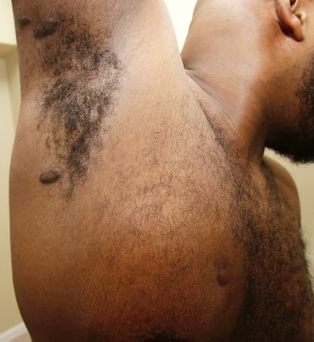 Gregory Love shows his gunshot wounds in Maple Heights, Ohio.
