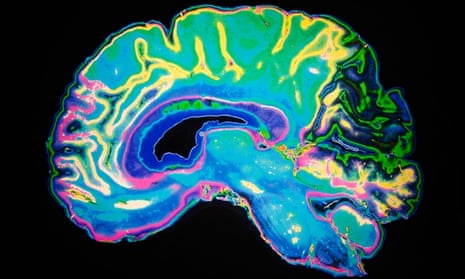 An artificially coloured MRI scan of a human brain.