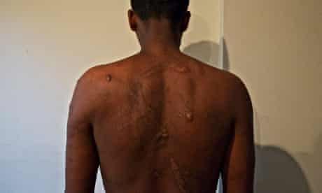 An Eritrean man shows the wounds he says traffickers inflicted on him